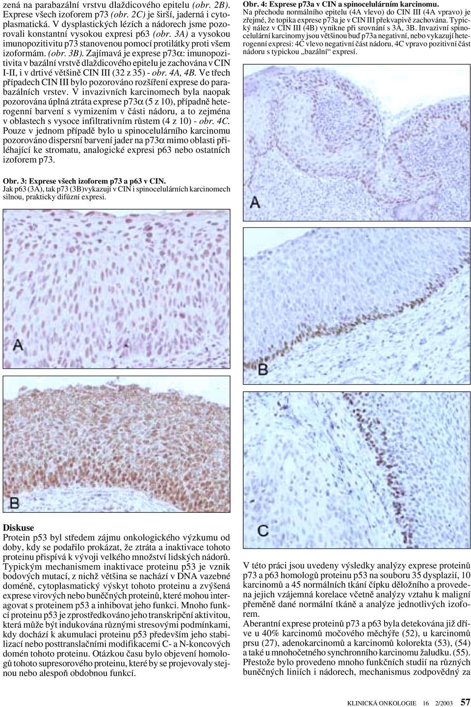 Zajímavá je exprese p73α: imunopozitivita v bazální vrstvû dlaïdicového epitelu je zachována v CIN I-II, i v drtivé vût inû CIN III (32 z 35) - obr. 4A, 4B.