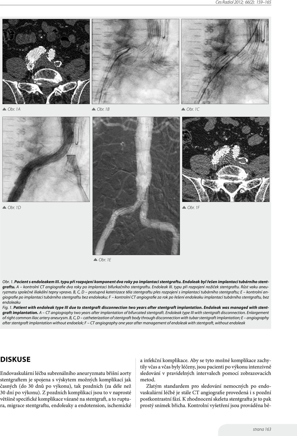 B, C, D postupná katetrizace těla stentgraftu přes rozpojení s implantací tubárního stentgraftu; E kontrolní angiografie po implantaci tubárního stentgraftu bez endoleaku; F kontrolní CT angiografie