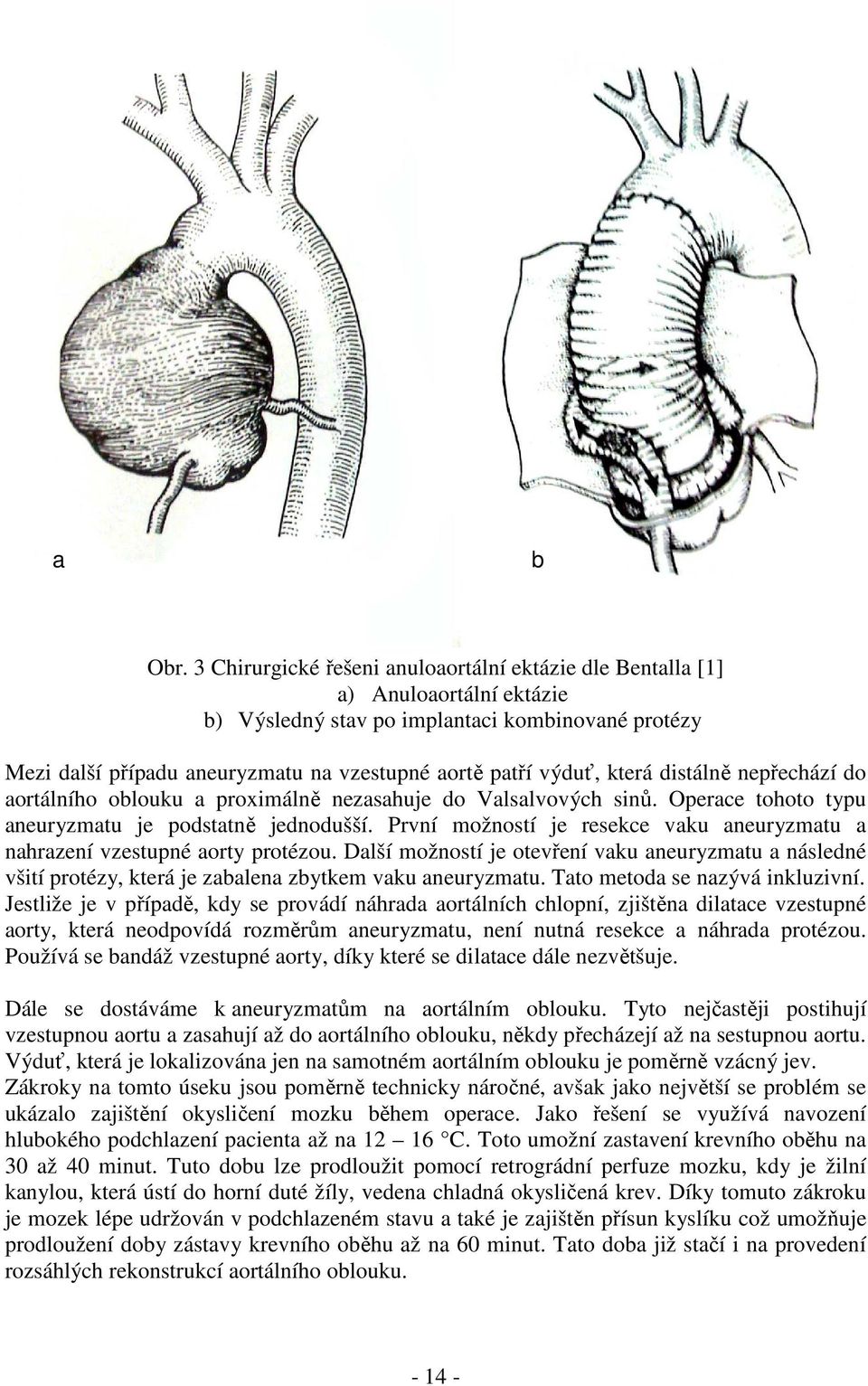 která distálně nepřechází do aortálního oblouku a proximálně nezasahuje do Valsalvových sinů. Operace tohoto typu aneuryzmatu je podstatně jednodušší.