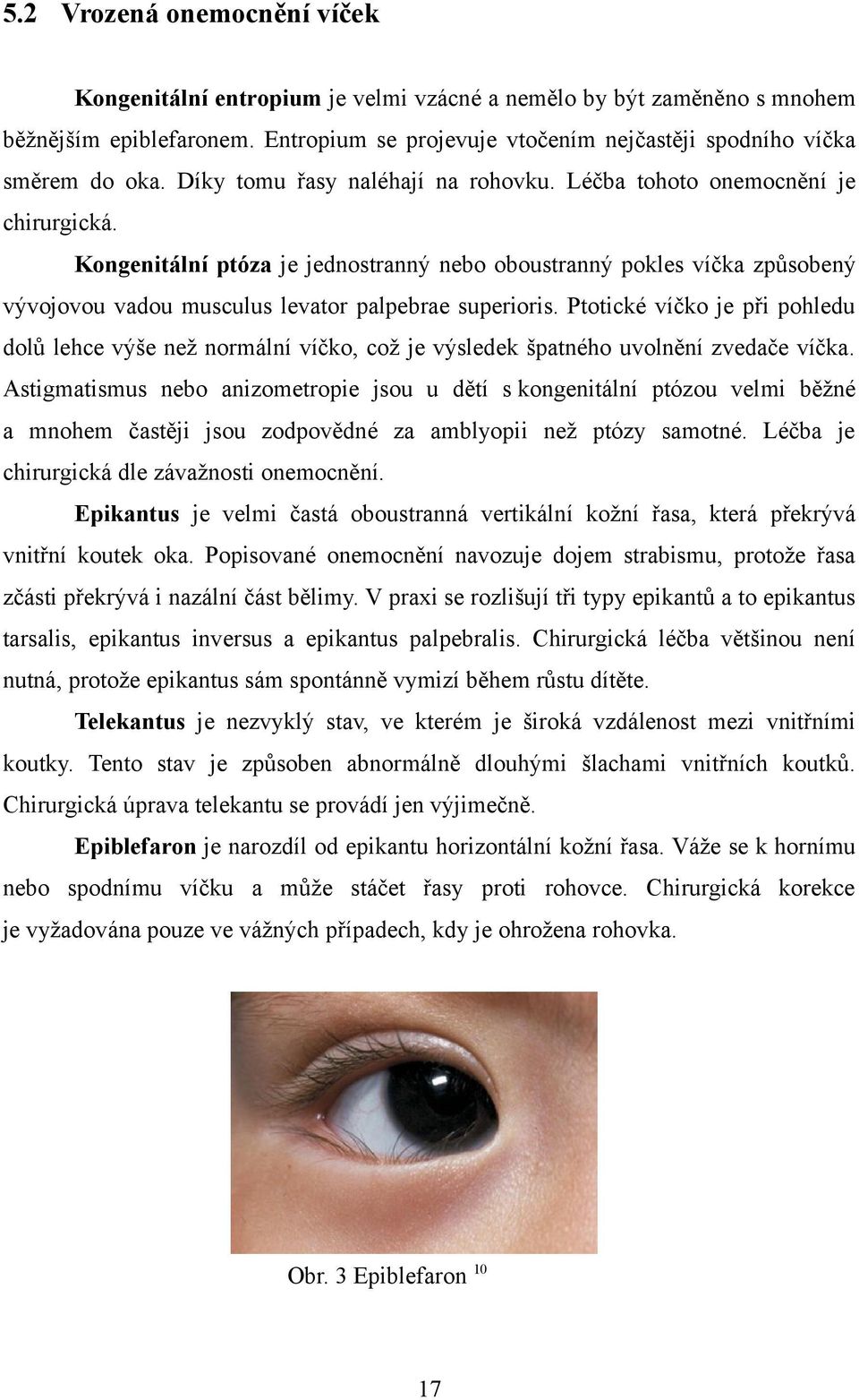 Kongenitální ptóza je jednostranný nebo oboustranný pokles víčka způsobený vývojovou vadou musculus levator palpebrae superioris.