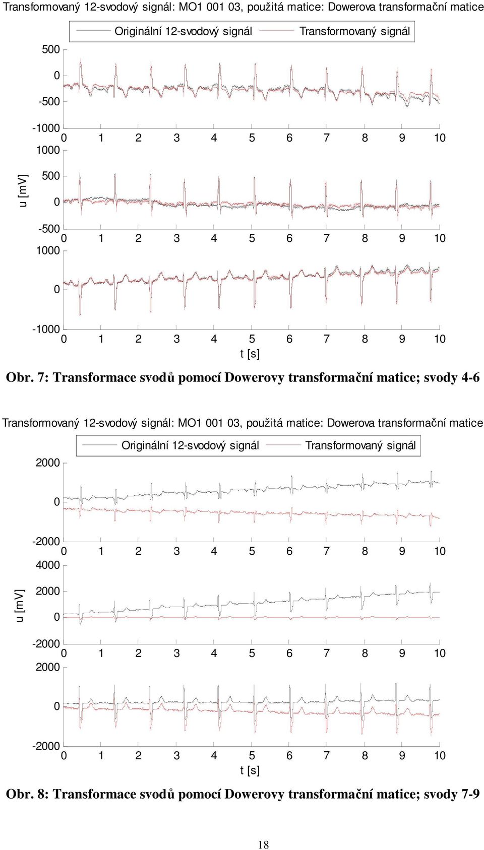 7: Transformace svodů pomocí Dowerovy transformační matice; svody 4-6 Transformovaný 12-svodový signál: MO1 1 3, použitá matice: Dowerova transformační