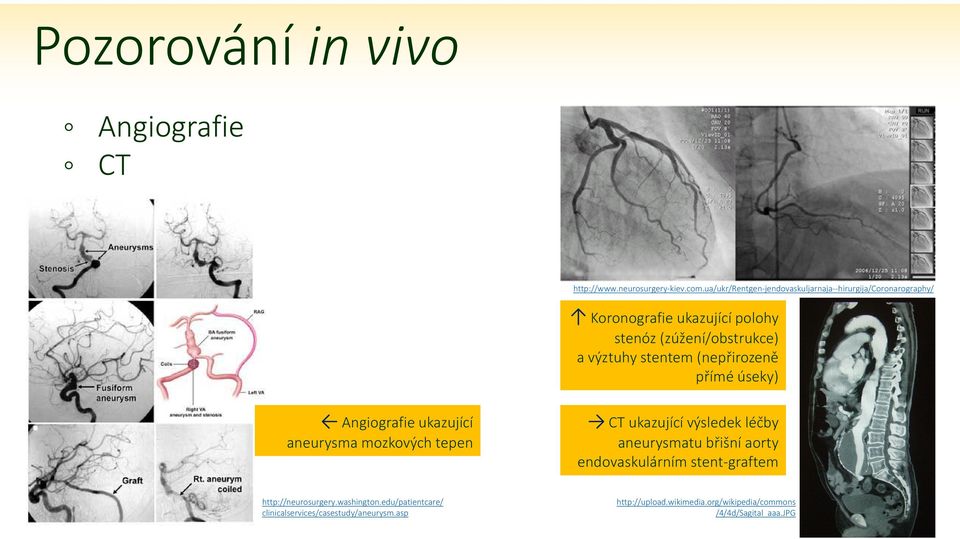 stentem (nepřirozeně přímé úseky) Angiografie ukazující aneurysma mozkových tepen CT ukazující výsledek léčby aneurysmatu břišní