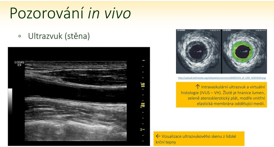 png Intravaskulární ultrazvuk a virtuální histologie (IVUS VH).