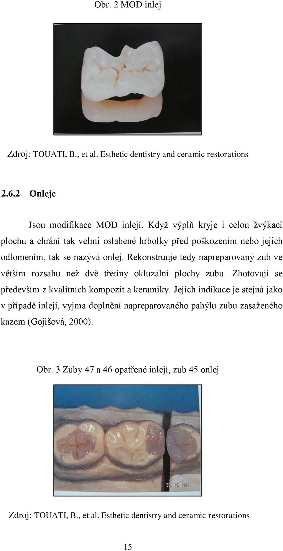 Rekonstruuje tedy napreparovaný zub ve větším rozsahu neţ dvě třetiny okluzální plochy zubu. Zhotovují se především z kvalitních kompozit a keramiky.