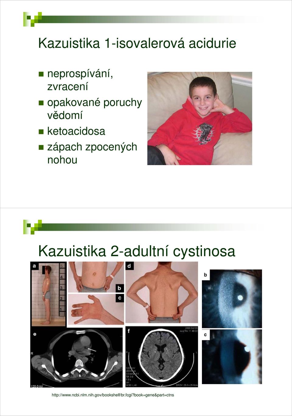 zpocených nohou Kazuistika 2-adultní cystinosa