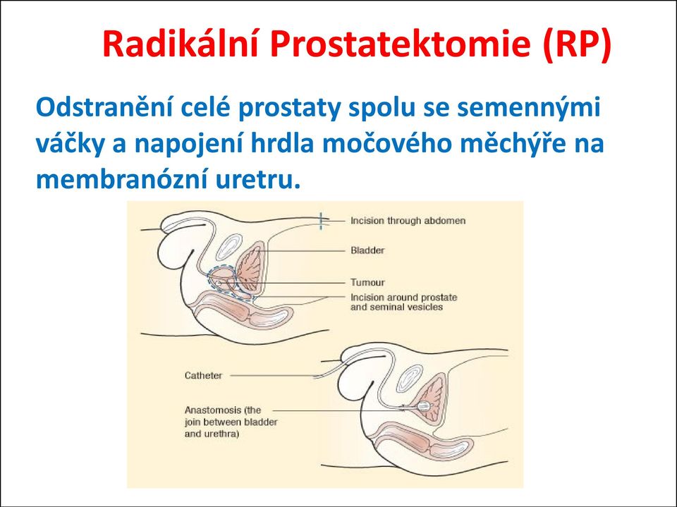 semennými váčky a napojení hrdla