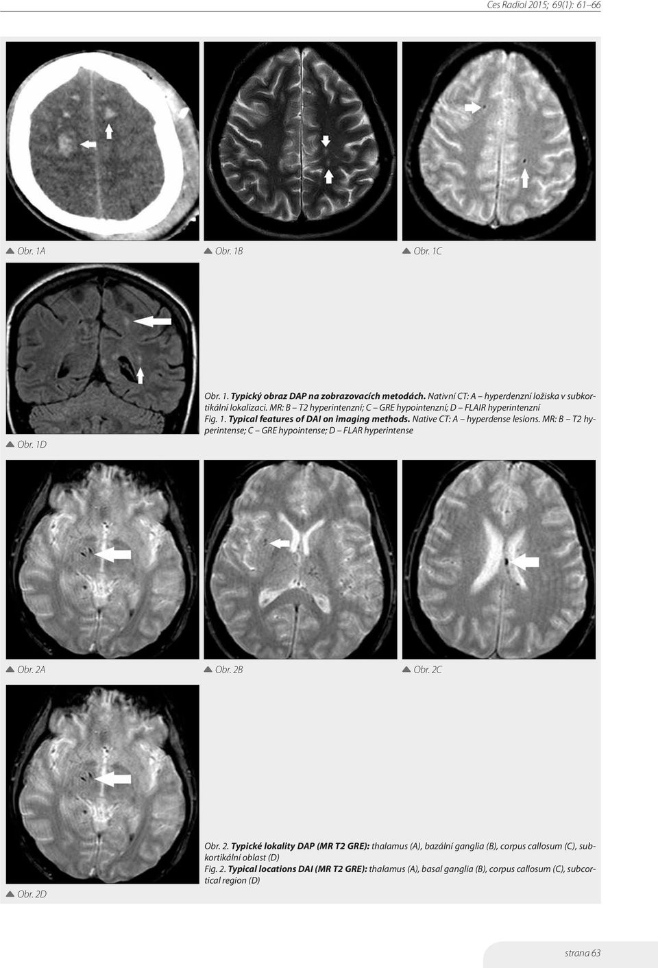 MR: B T2 hyperintense; C GRE hypointense; D FLAR hyperintense Obr. 2A