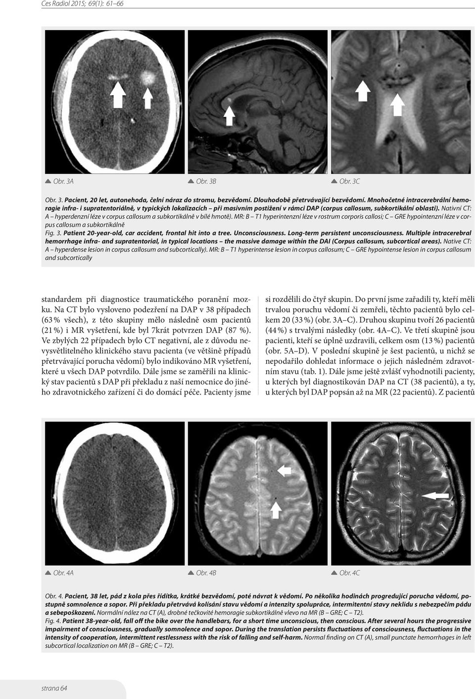 Nativní CT: A hyperdenzní léze v corpus callosum a subkortikálně v bílé hmotě). MR: B T1 hyperintenzní léze v rostrum corporis callosi; C GRE hypointenzní léze v corpus callosum a subkortikálně Fig.