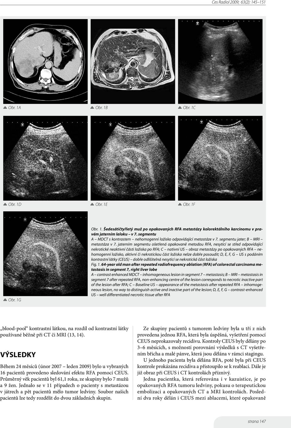 jaterním segmentu ošetřená opakovaně metodou RFA, nesytící se střed odpovídající nekrotické neaktivní části ložiska po RFA; C nativní US obraz metastázy po opakovaných RFA nehomogenní ložisko,