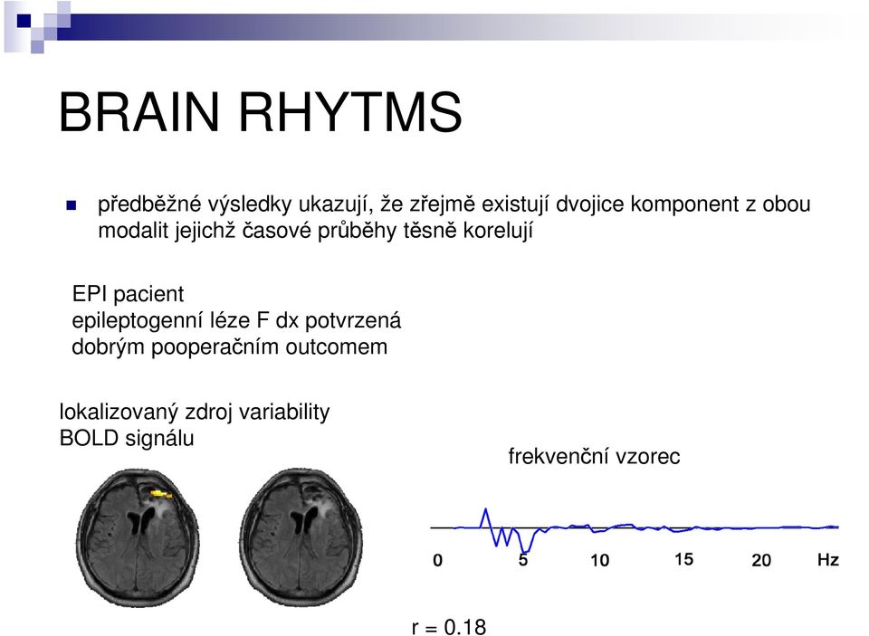 pacient epileptogenní léze F dx potvrzená dobrým pooperačním