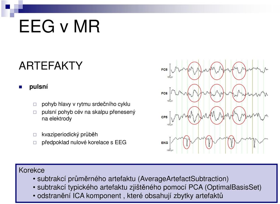 subtrakcí průměrného artefaktu (AverageArtefactSubtraction) subtrakcí typického artefaktu