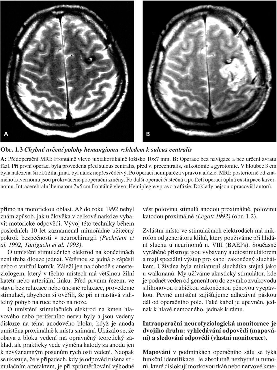 Po operaci hemiparéza vpravo a afázie. MRI: posteriorně od známého kavernomu jsou prokrvácené pooperační změny. Po další operaci částečná a po třetí operaci úplná exstirpace kavernomu.