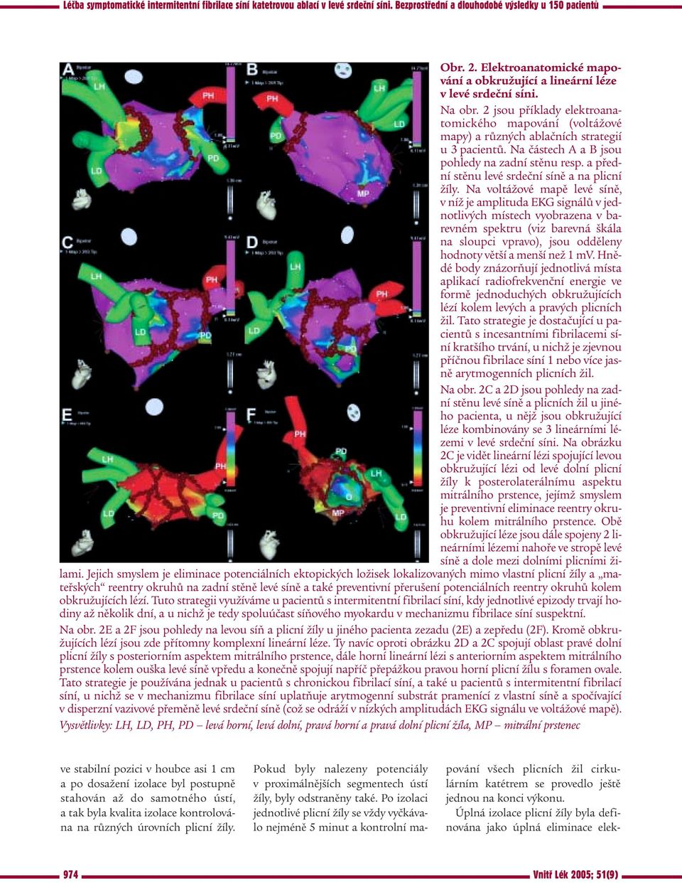 Na voltážové mapě levé síně, v níž je amplituda EKG signálů v jednotlivých místech vyobrazena v barevném spektru (viz barevná škála na sloupci vpravo), jsou odděleny hodnoty větší a menší než 1 mv.