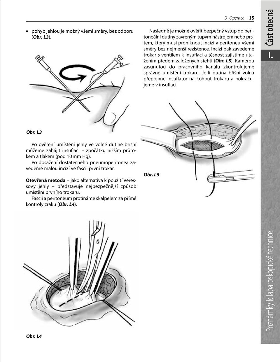 Incizí pak zavedeme trokar s ventilem k insuflaci a těsnost zajistíme utažením předem založených stehů (Obr. L5). Kamerou zasunutou do pracovního kanálu zkontrolujeme správné umístění trokaru.