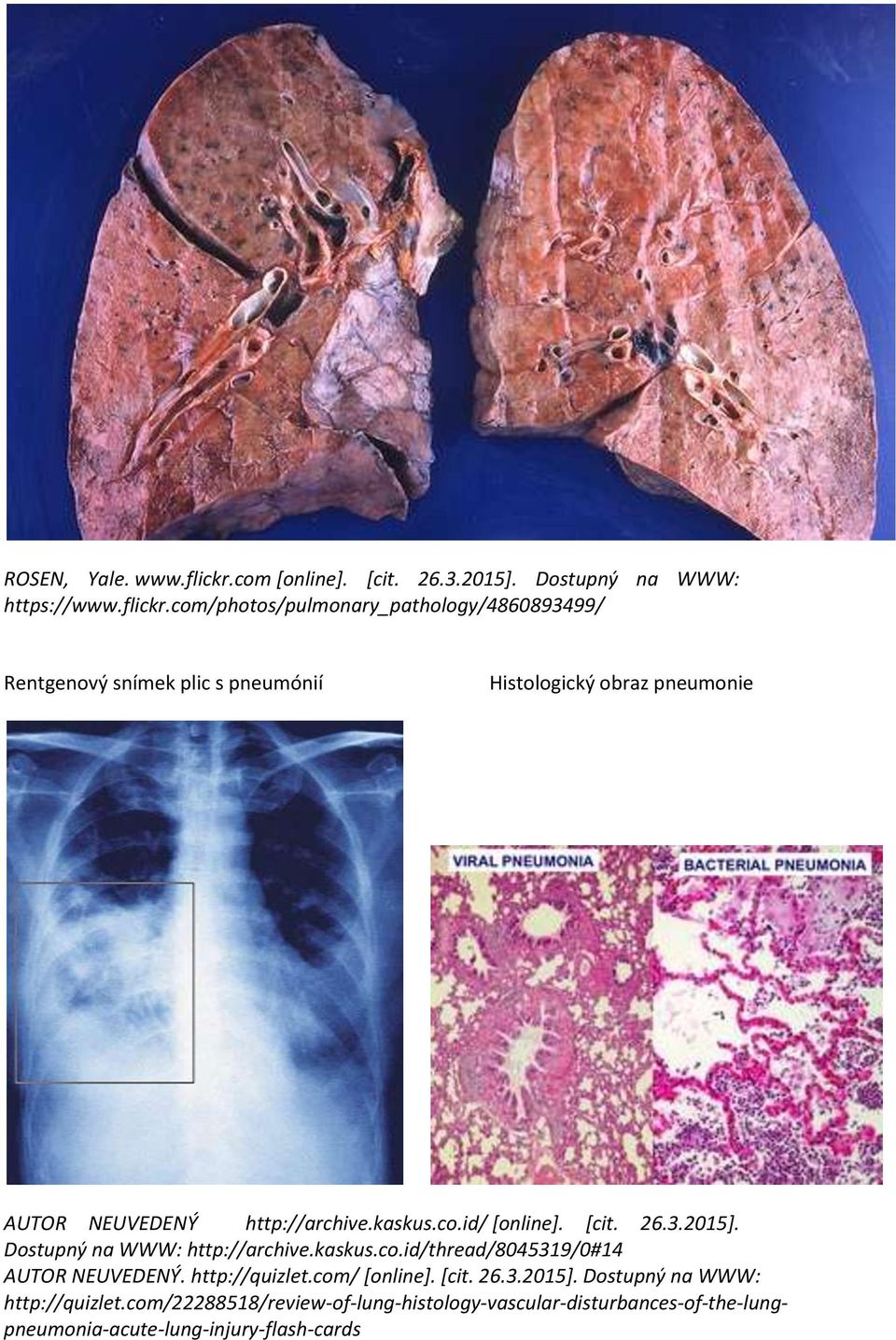 com/photos/pulmonary_pathology/4860893499/ Rentgenový snímek plic s pneumónií Histologický obraz pneumonie AUTOR NEUVEDENÝ