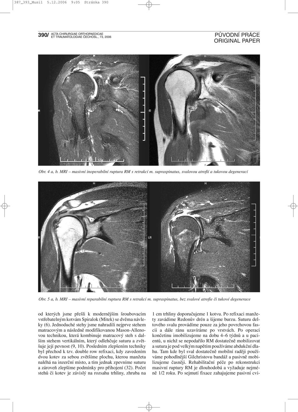 supraspinatus, bez svalové atrofie či tukové degenerace od kterých jsme přešli k modernějším šroubovacím vstřebatelným kotvám Spiralok (Mitek) se dvěma návleky (6).