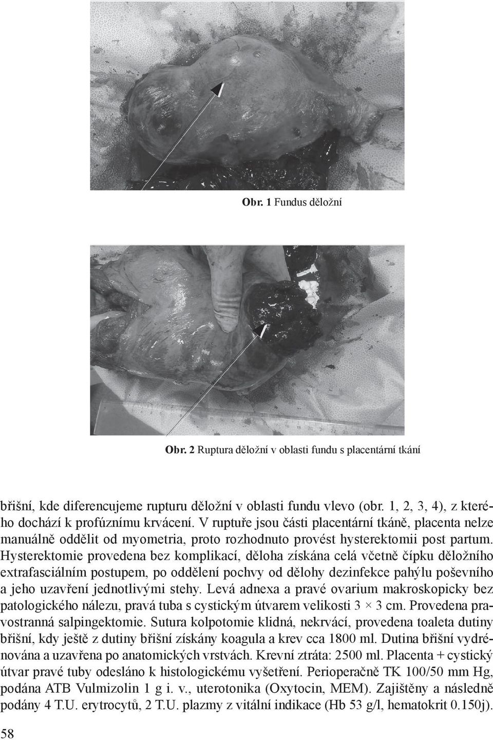 Hysterektomie provedena bez komplikací, děloha získána celá včetně čípku děložního extrafasciálním postupem, po oddělení pochvy od dělohy dezinfekce pahýlu poševního a jeho uzavření jednotlivými