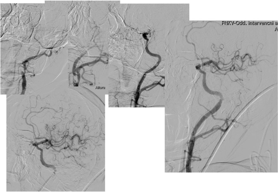 anterior stroke