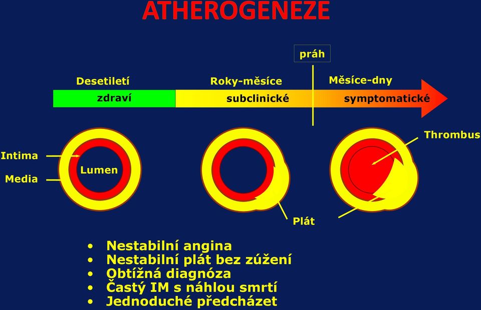 Lumen Nestabilní angina Nestabilní plát bez zúžení