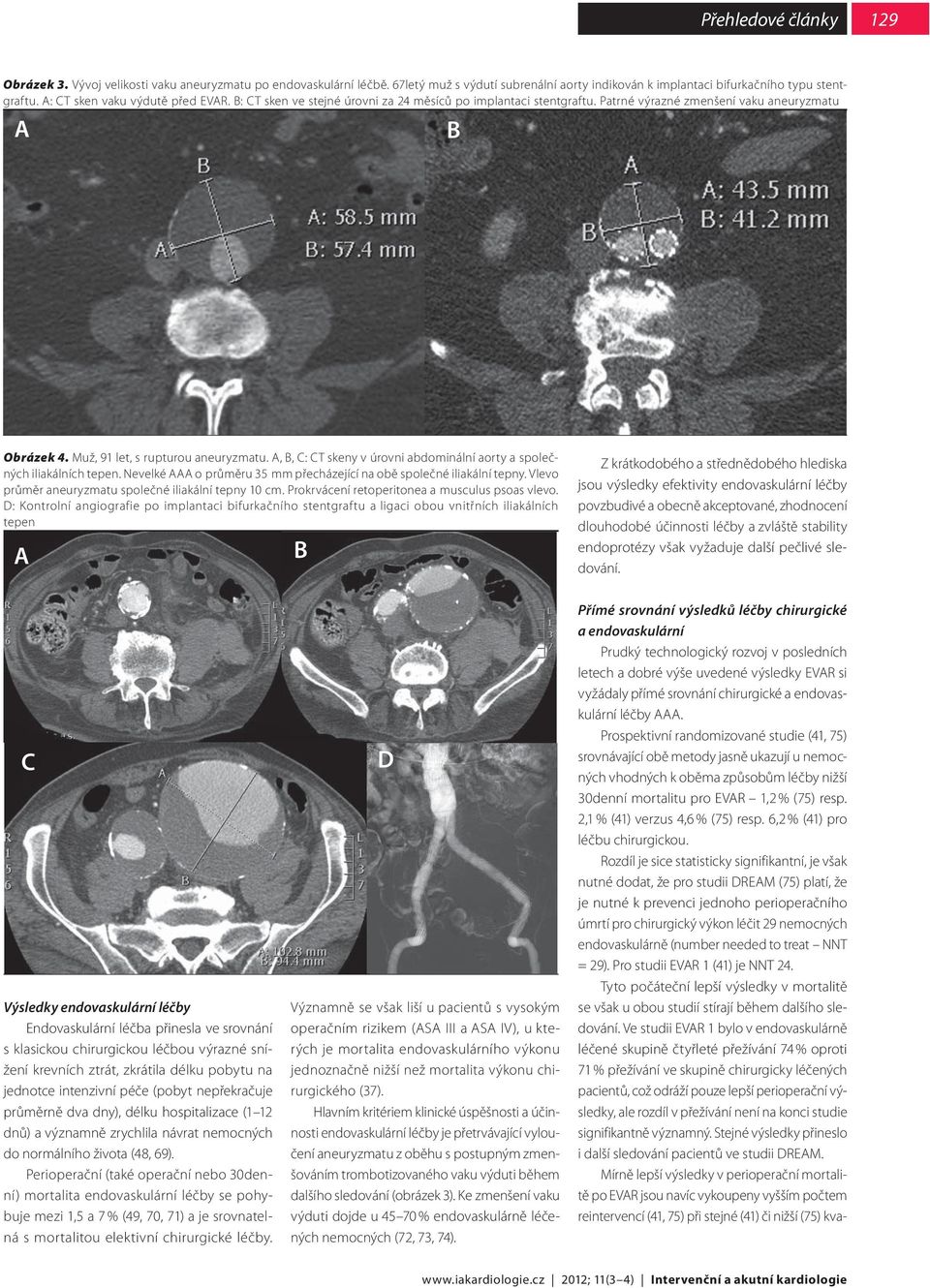 A, B, C: CT skeny v úrovni abdominální aorty a společných iliakálních tepen. Nevelké AAA o průměru 35 mm přecházející na obě společné iliakální tepny.