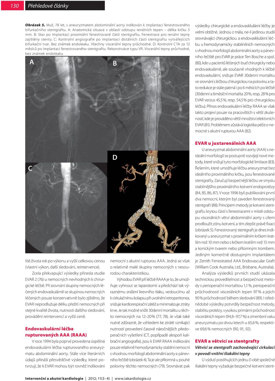 C: Kontrolní angiografie po implantaci distálních částí stentgraftu vytvářejících bifurkační tvar. Bez známek endoleaku. Všechny viscerální tepny průchodné.