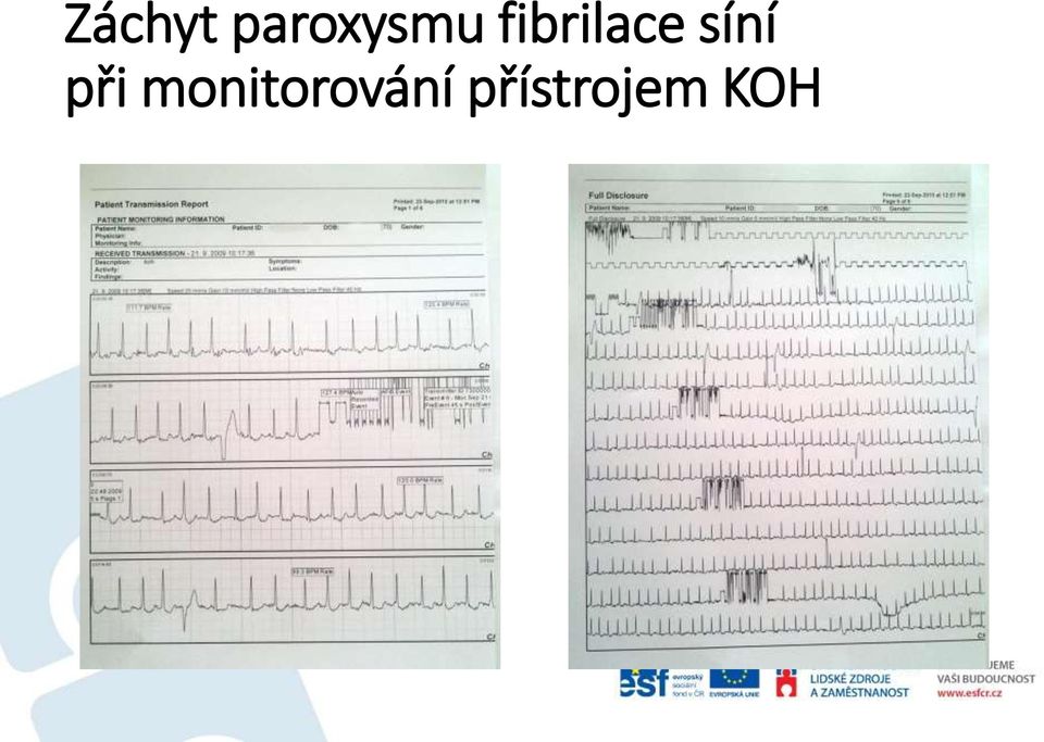 fibrilace síní