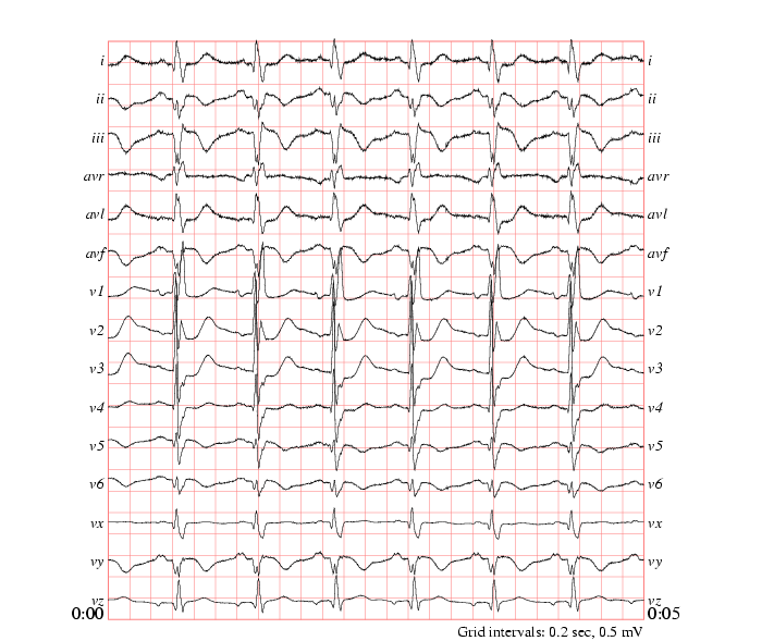 Kompletní pacientský monitor EKG ze světové databáze Physionet na