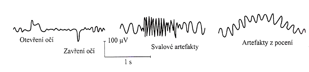 5.3 Rušení signálu EEG Stejně jako biologické signály i záznam elektrické aktivity mozku může být ovlivněn přítomností rušení, nebo obsahuje neadekvátní složky.