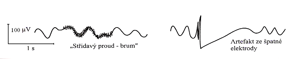 Obrázek 5 Technické artefakty (převzato z [17]) 5.4 Popis EEG EEG je úzce spjato se stavem vědomí měřené osoby.