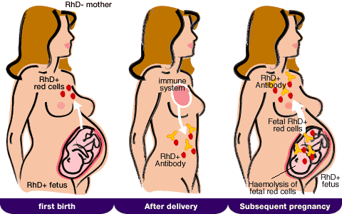 Erytrocytární aloimunizace v těhotenství Aloimunizace matky Transplacentární přenos protilátek do