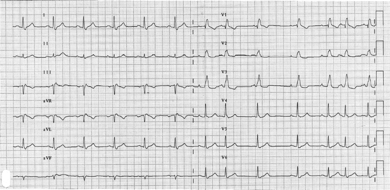 Obrázek 3 EKG záznam po RF ablaci srdce. Po výkonu byl pacient bez dušnosti a nepociťoval žádnou bolest, avšak AS nebyla zcela pravidelná.