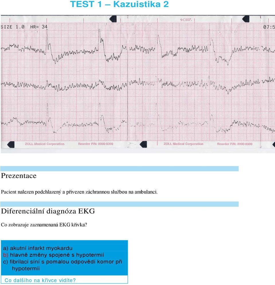 Diferenciální diagnóza EKG Co zobrazuje zaznamenaná EKG křivka?