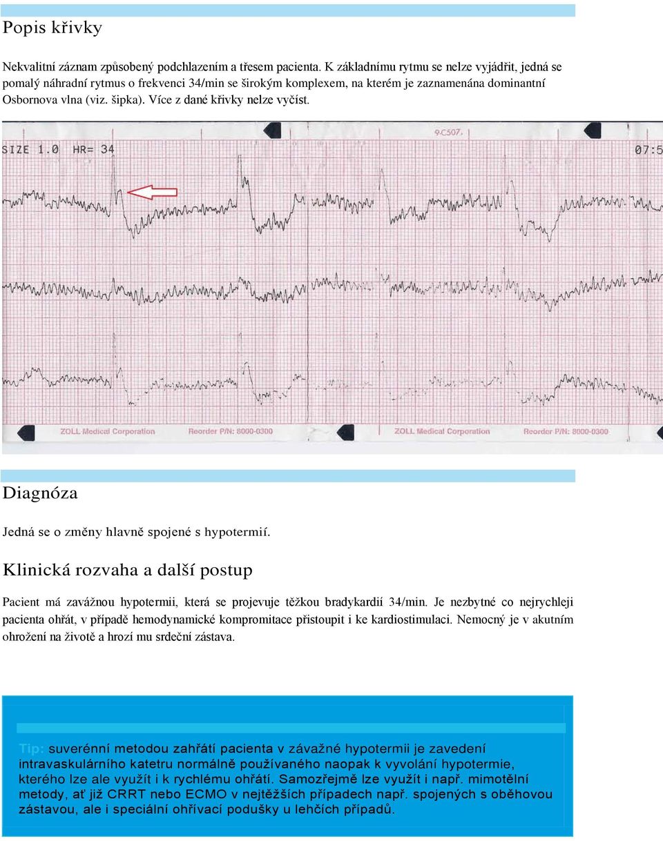 Více z dané křivky nelze vyčíst. Diagnóza Jedná se o změny hlavně spojené s hypotermií. Klinická rozvaha a další postup Pacient má zavážnou hypotermii, která se projevuje těžkou bradykardií 34/min.