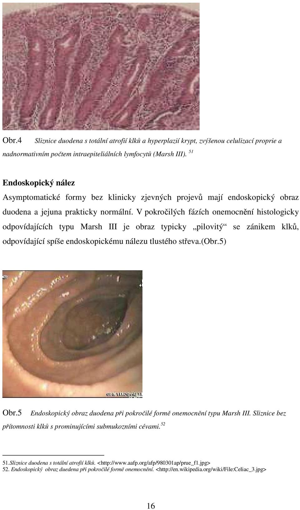 V pokročilých fázích onemocnění histologicky odpovídajících typu Marsh III je obraz typicky pilovitý se zánikem klků, odpovídající spíše endoskopickému nálezu tlustého střeva.(obr.5) 5 Obr.