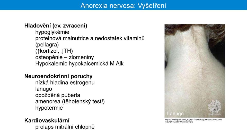 zlomeniny Hypokalemic hypokalcemická M Alk Neuroendokrinní poruchy nízká hladina estrogenu lanugo opožděná