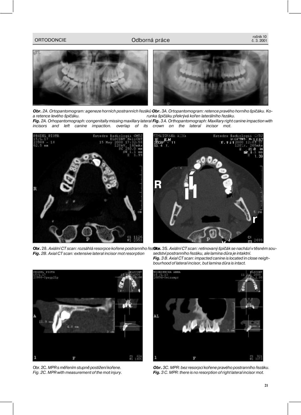 Orthopantomograph: Maxillary right canine impaction with incisors and left canine impaction. overlap of its crown on the lateral incisor mot..,.. ;.- :.- A:;:IA 1E ll.h 2EG9* - 11 53. 4 T. = :.