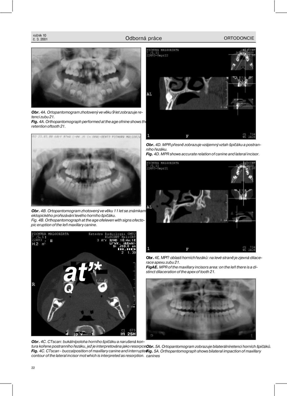 Ortopantomogram zhotovený ve věku 11 let se známkami ektopického prořezávání levého horního špičáku. Fig. 4B.