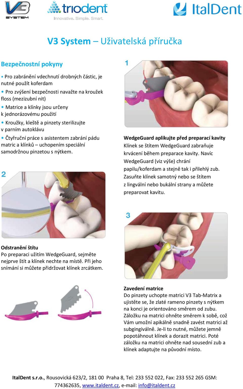 nýtkem. WedgeGuard aplikujte před preparací kavity Klínek se štítem WedgeGuard zabraňuje krvácení během preparace kavity.