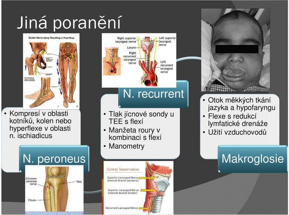 recurrent Tlak jícnové sondy u TEE s flexí Manžeta roury v kombinaci s