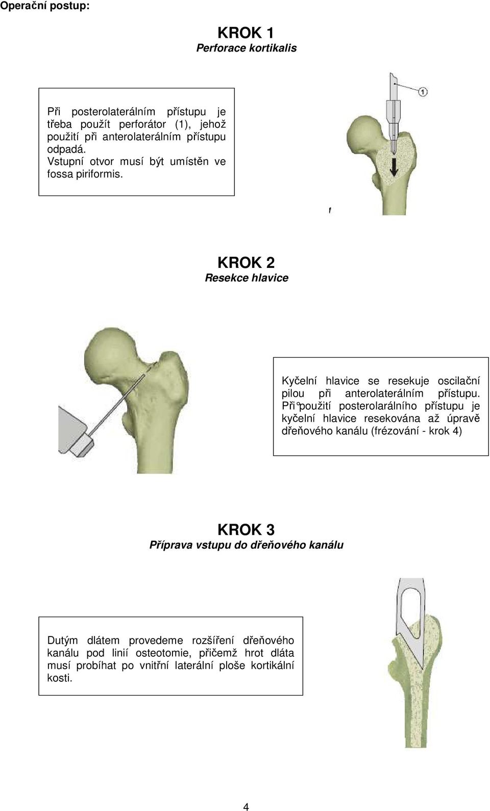 KROK 2 Resekce hlavice Kyčelní hlavice se resekuje oscilační pilou při anterolaterálním přístupu.