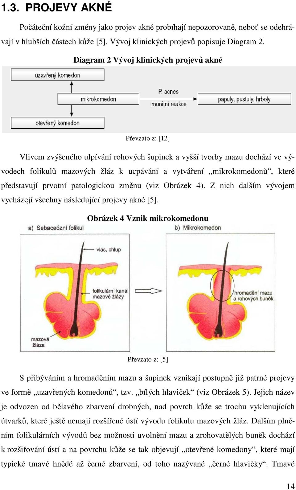 mikrokomedonů, které představují prvotní patologickou změnu (viz Obrázek 4). Z nich dalším vývojem vycházejí všechny následující projevy akné [5].