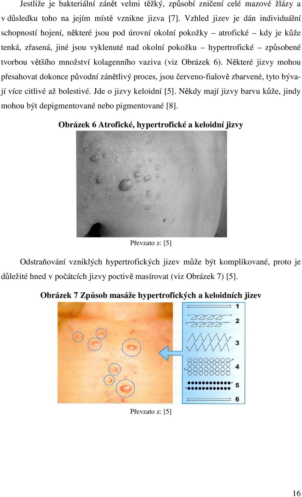 většího množství kolagenního vaziva (viz Obrázek 6). Některé jizvy mohou přesahovat dokonce původní zánětlivý proces, jsou červenofialově zbarvené, tyto býva jí více citlivé až bolestivé.