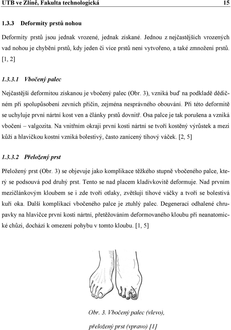 3.1 Vbočený palec Nejčastější deformitou získanou je vbočený palec (Obr. 3), vzniká buď na podkladě dědičném při spolupůsobení zevních příčin, zejména nesprávného obouvání.