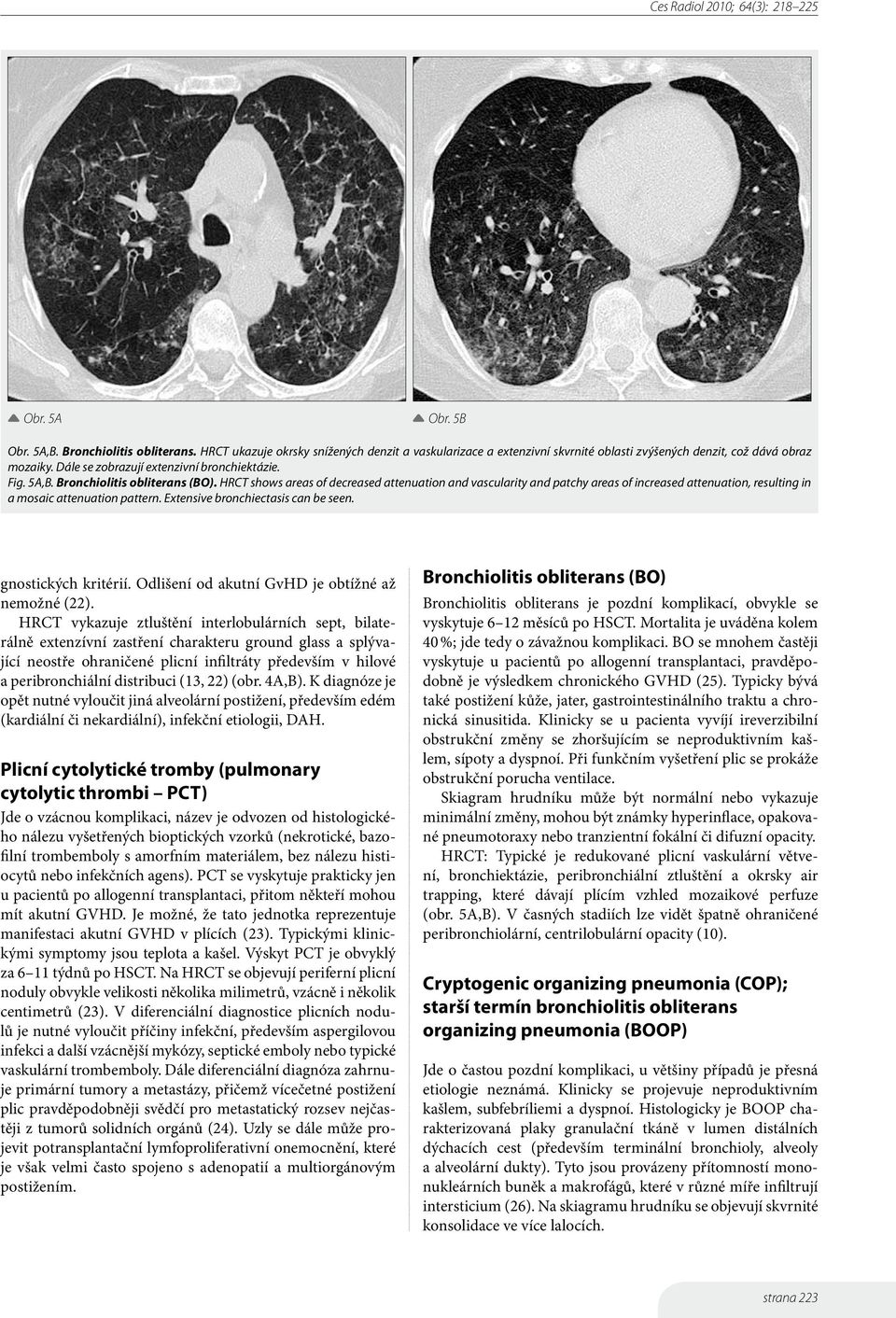 HRCT shows areas of decreased attenuation and vascularity and patchy areas of increased attenuation, resulting in a mosaic attenuation pattern. Extensive bronchiectasis can be seen.