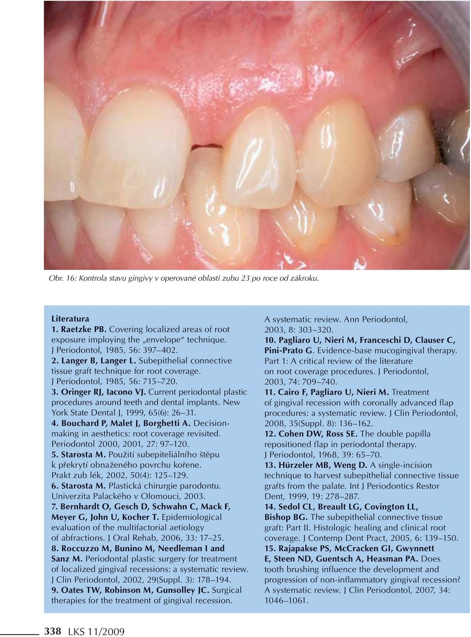 Current periodontal plastic procedures around teeth and dental implants. New York State Dental J, 1999, 65(6): 26 31. 4. Bouchard P, Malet J, Borghetti A.