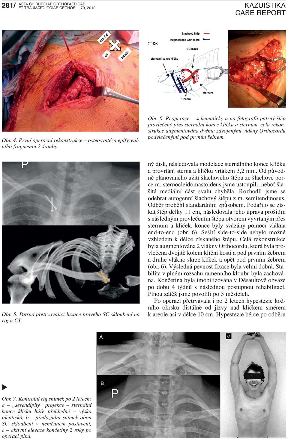 Kontrolní rtg snímek po 2 letech: a serendipity projekce sternální konce klíčku hůře přehledné výška identická, b předozadní snímek obou SC skloubení v neměnném postavení, c aktivní elevace končetiny