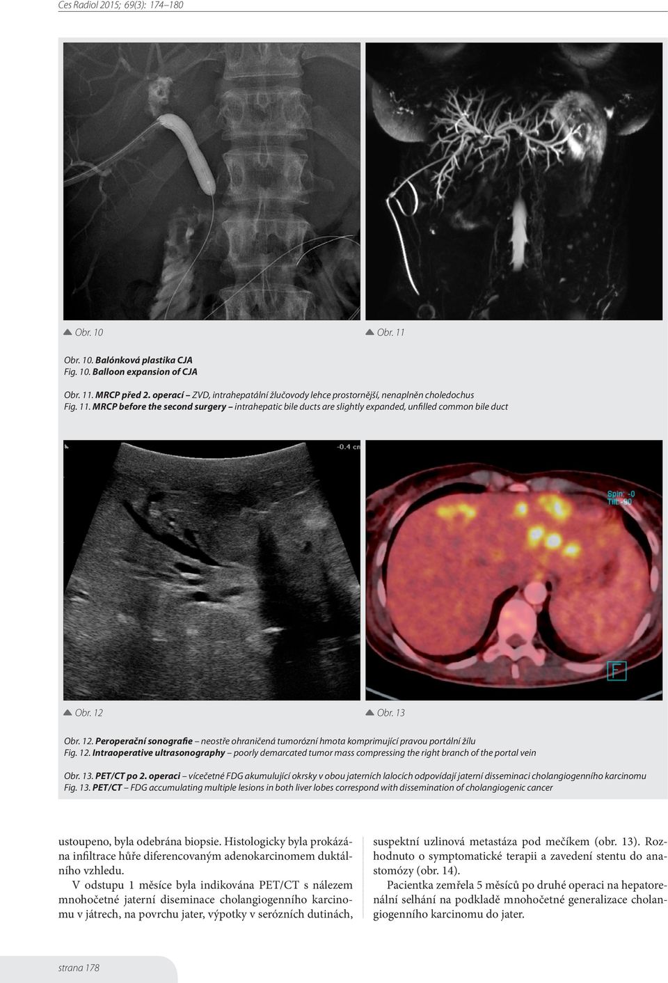 13. PET/CT po 2. operaci vícečetné FDG akumulující okrsky v obou jaterních lalocích odpovídají jaterní disseminaci cholangiogenního karcinomu Fig. 13.