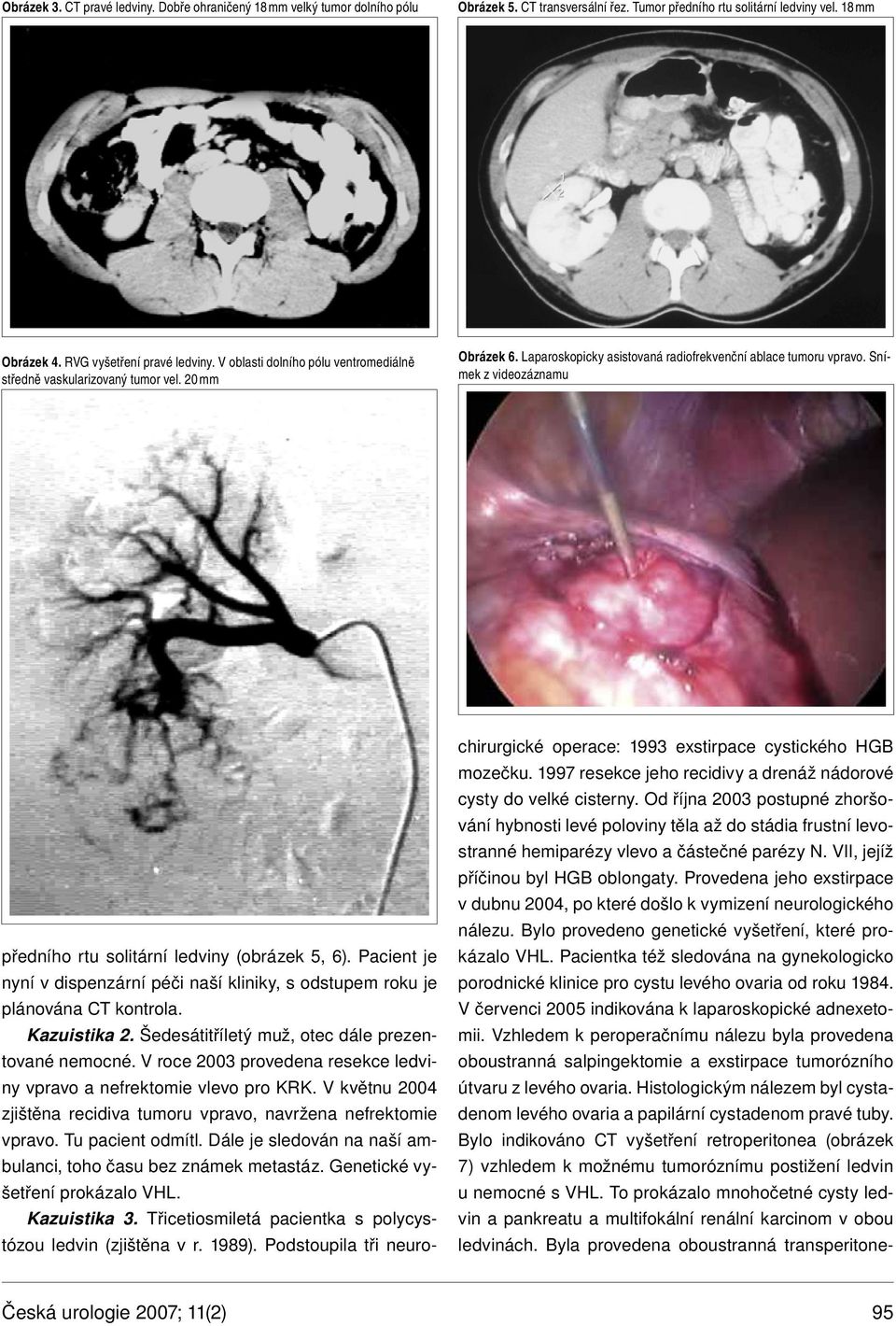 Snímek z videozáznamu předního rtu solitární ledviny (obrázek 5, 6). Pacient je nyní v dispenzární péči naší kliniky, s odstupem roku je plánována CT kontrola. Kazuistika 2.