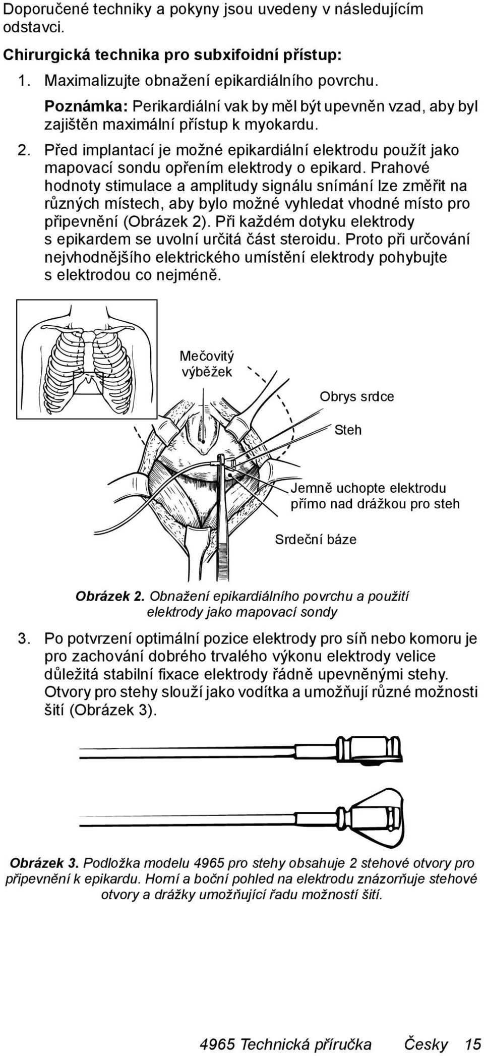 Před implantací je možné epikardiální elektrodu použít jako mapovací sondu opřením elektrody o epikard.