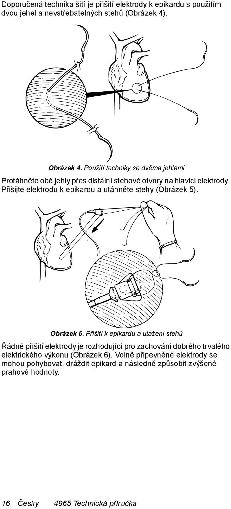 Přišijte elektrodu k epikardu a utáhněte stehy (Obrázek 5). Obrázek 5.